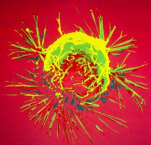 خلية سرطان الثدي أُلتقطت بواسطة المجهر الالكتروني المسحي. المصدر: المعهد الوطني للسرطان - National Cancer Institute